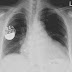 Medical Devices Vulnerable to Hacking