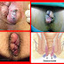 buang air besar keluar darah dan lendir thumbnail