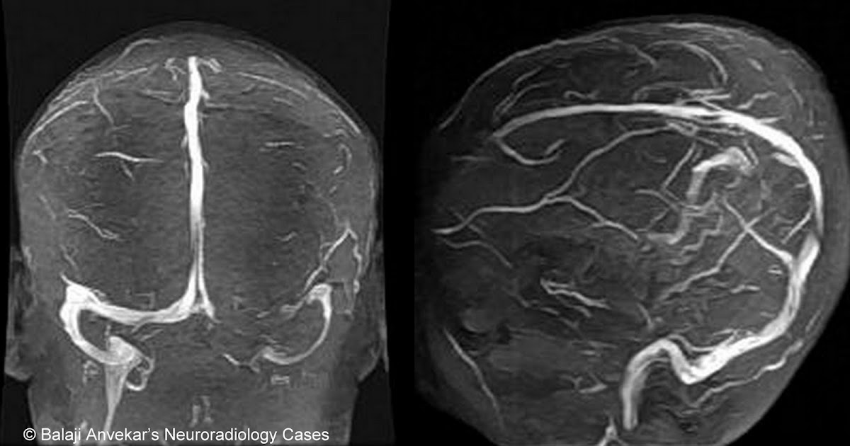 Neuroradiology Cases Hypoplastic transverse sinus MRI