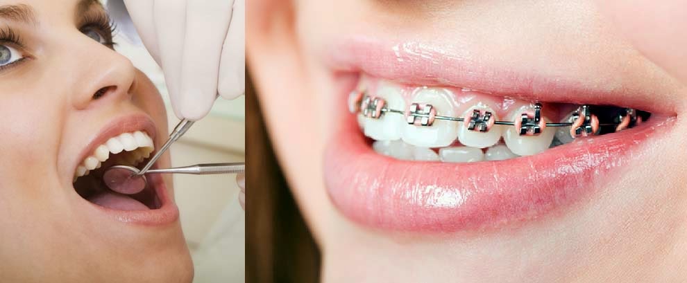 Traditional braces Treatment