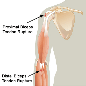 Bottom Of Bicep Pain
