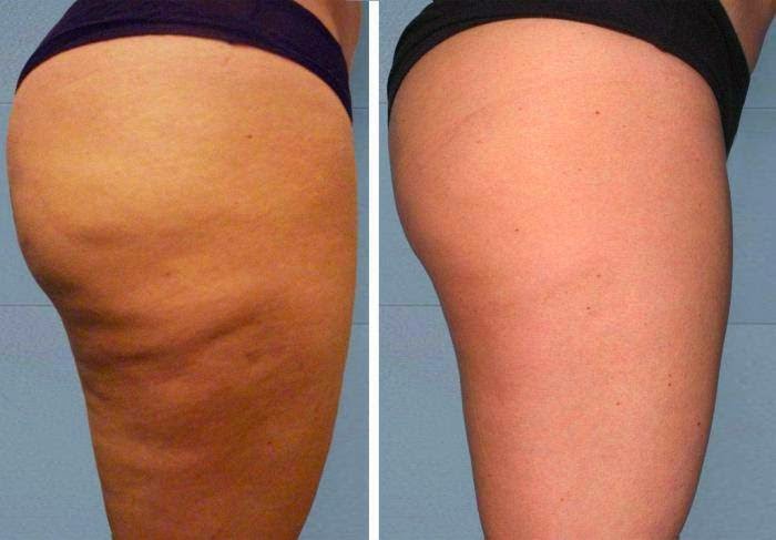reductor de celulitis