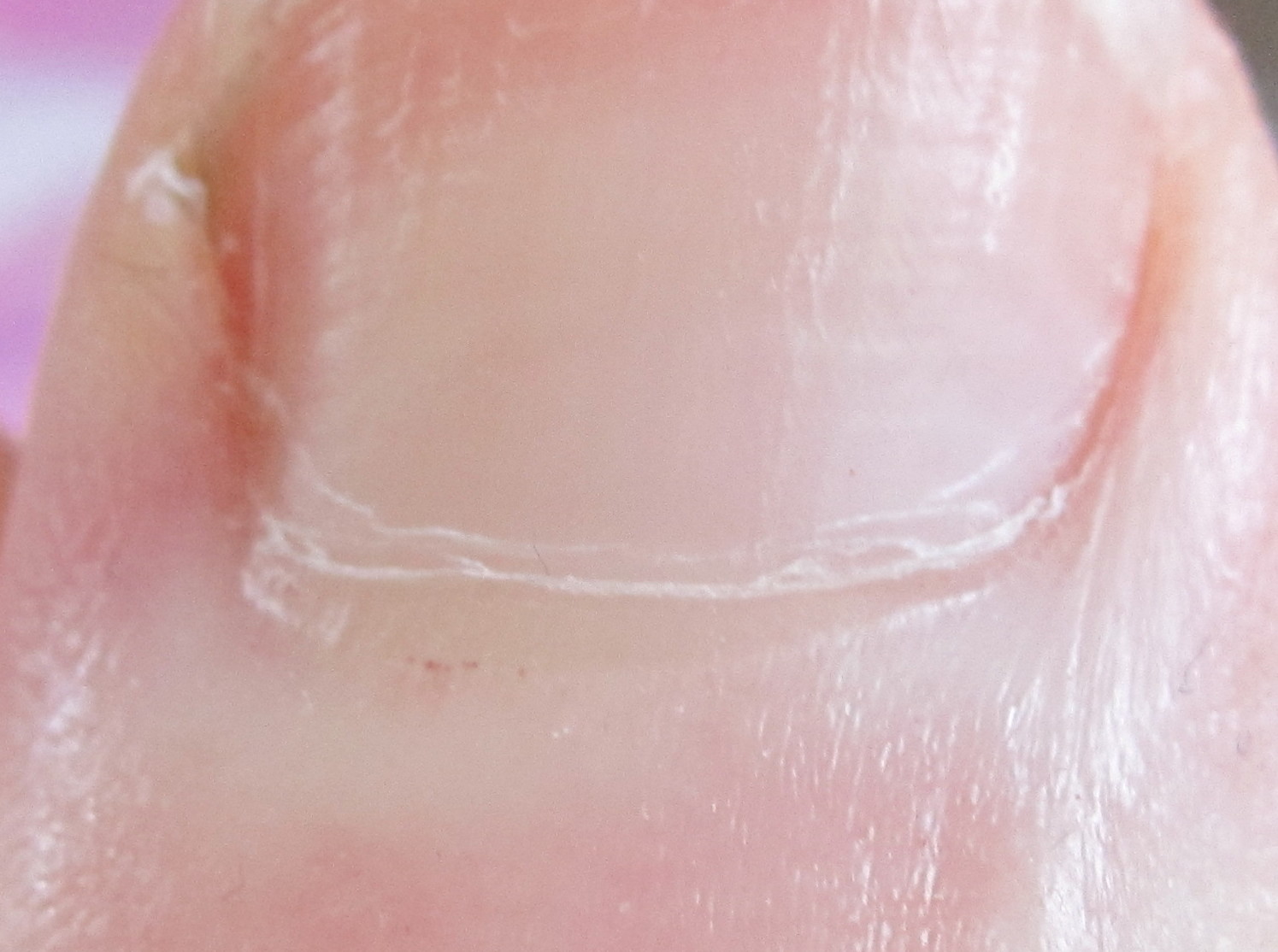 Who Needs Doctors Finger Nail Capillary Time Line