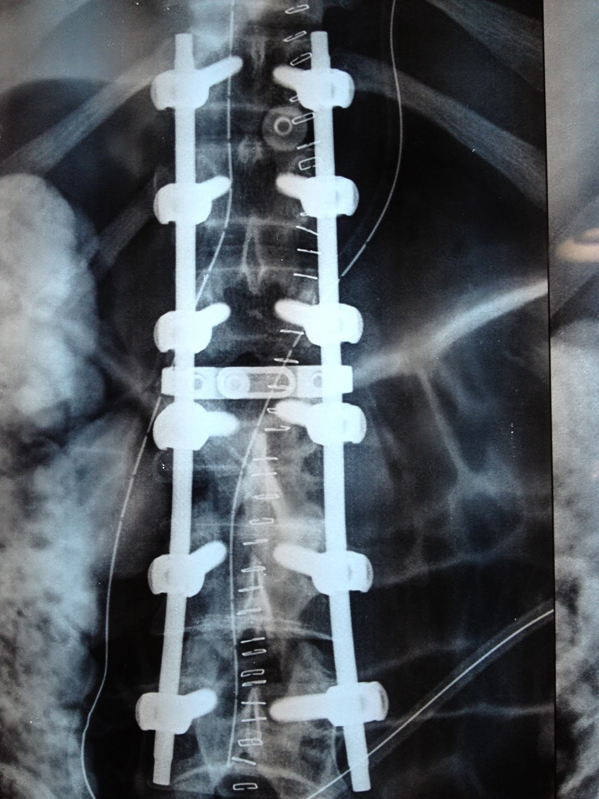 Key Hole Spine Surgery