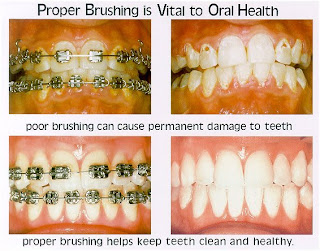 teeth brushing oral brush properly poor stains braces hygiene cavities cleaning brace tools become maintaining mouth health stain proper spots