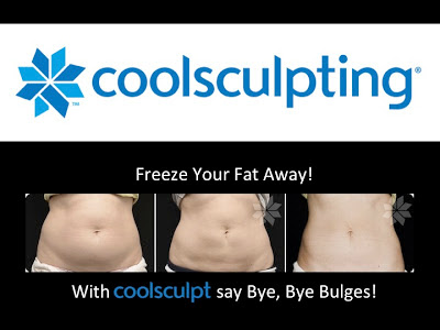 Coolsculpting Mclean VA