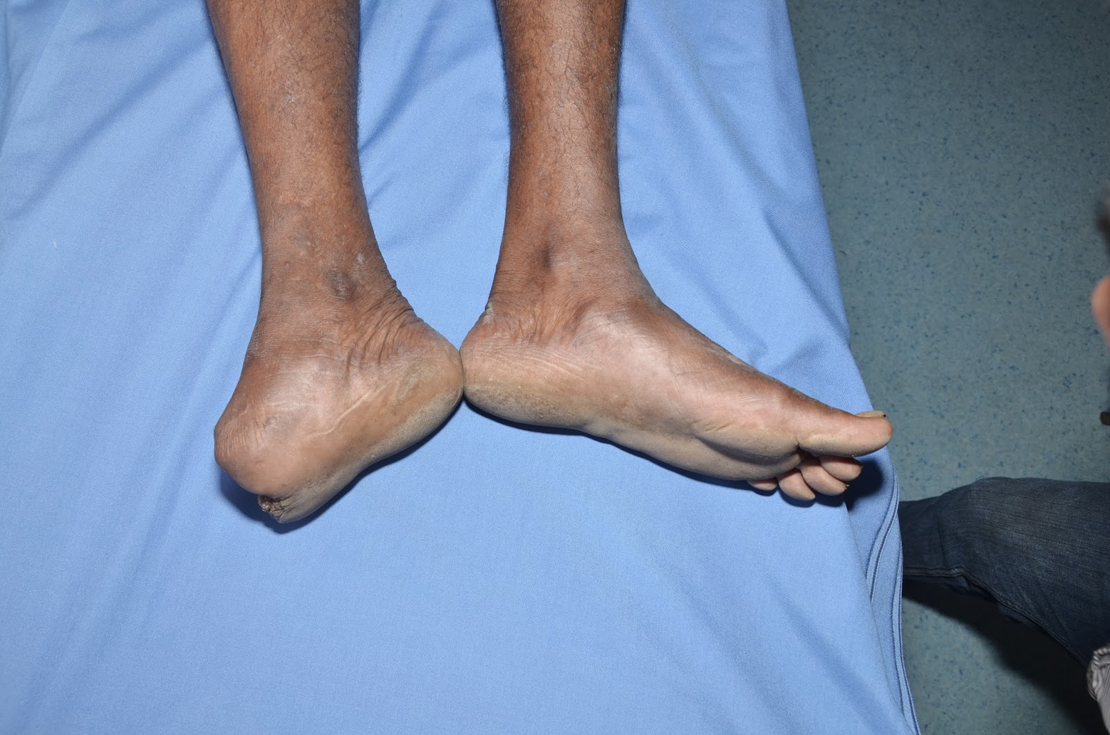 TRAUMATIC AMPUTATION OF MIDFOOT CRUSH INJURY FOOT, LOWER LIMB