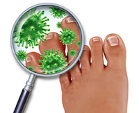 Dallas Toenail fungus laser treatment - Infinity Foot & Ankle