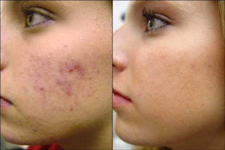 eliminar manchas de acne