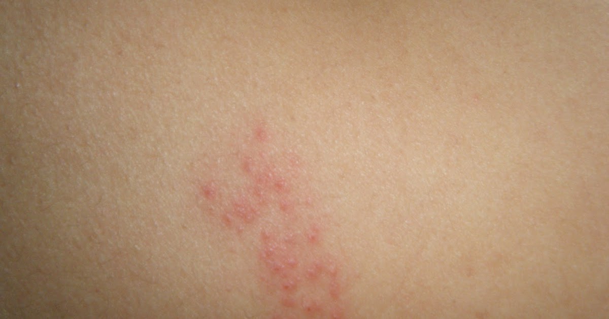 21 and Shingles Day 8 waiting for blisters to pop!