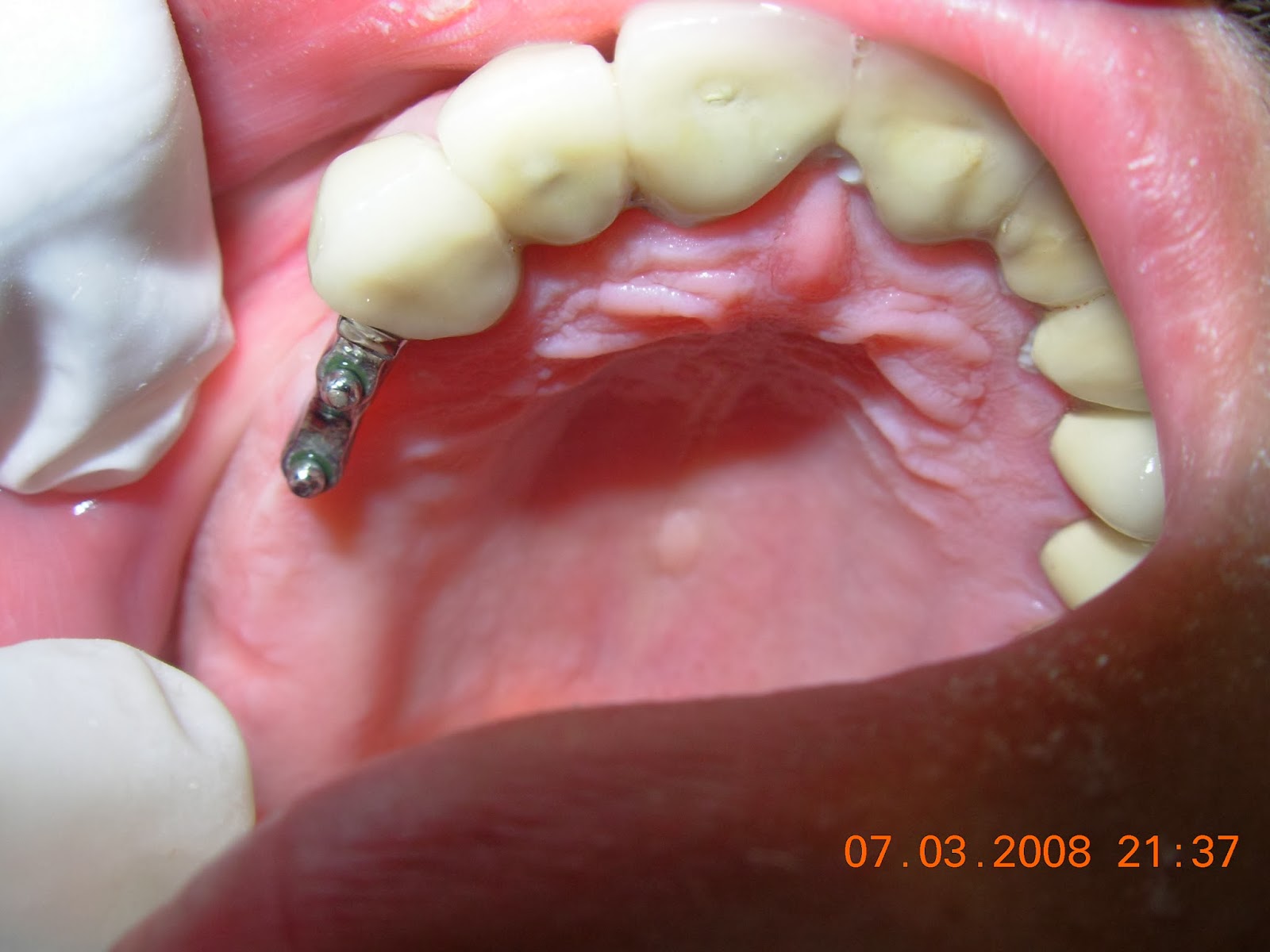 P.K. Dental Clinic CASE Precision attachment RPD