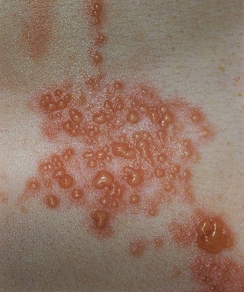 Recognizing the Type on Genital Herpes Treatment