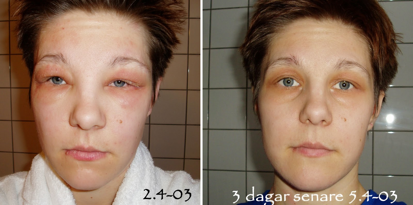 Ingeborg's Lotta: Eksem och diskbråck C6-C7 Ingeborg's Lotta: Eksem och diskbråck C6-C7
