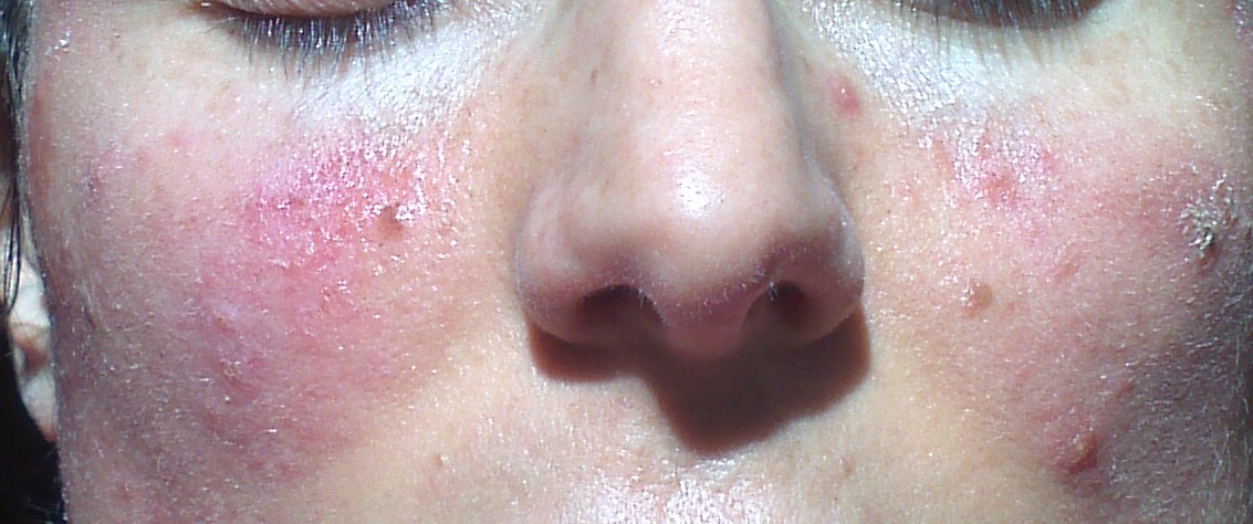 MRSA versus Garlic the Allimed Challenge - healing hacker
