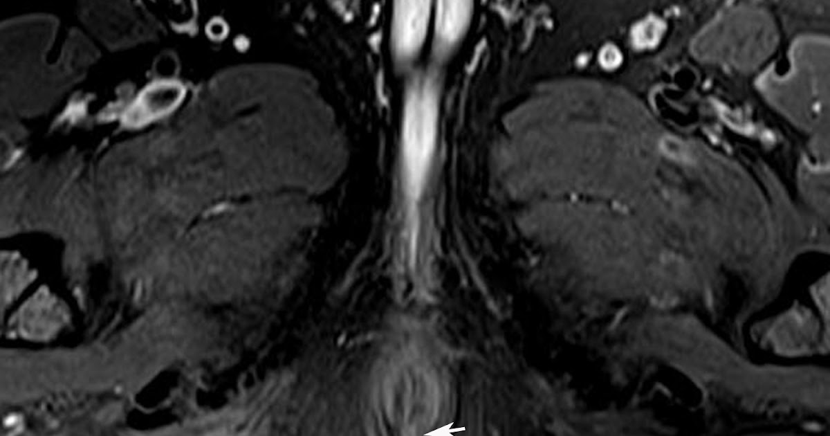 Radiodiagnosis - Imaging is Amazing-Interesting cases: Perianal Fistula