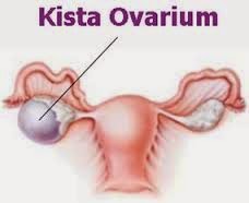 Obat Tradisional Kista Ovarium yang Ampuh