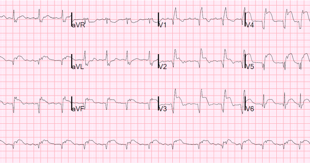 st elevation secondary to ivcd st elevation secondary to ivcd