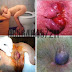 Obat Wasir Ambeven Resep Dokter Herbal thumbnail