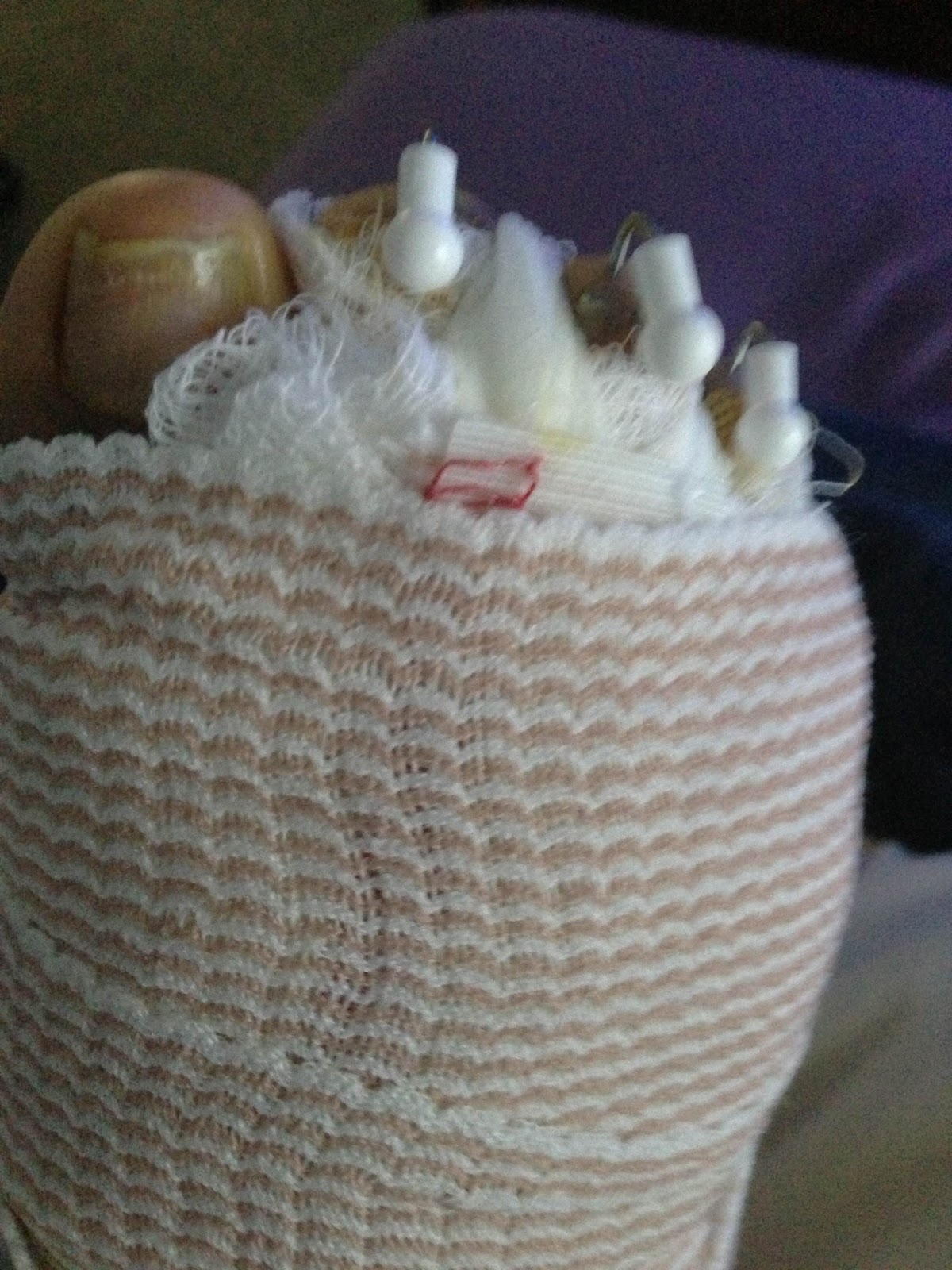 Hammer Toe Caused By Bunion thersacockrill’s blog