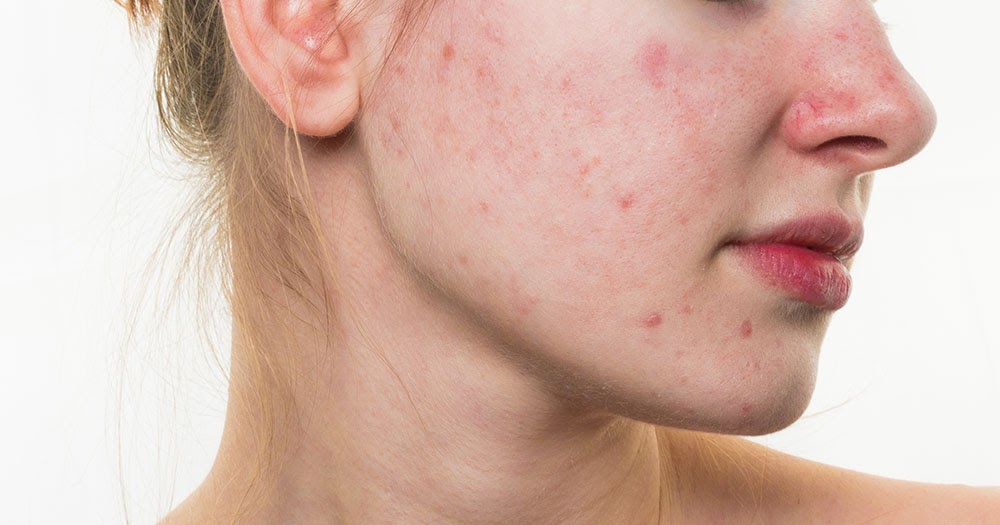 Como Curar La Rosacea 7 Remedios Naturales Para Eliminar La Rosacea