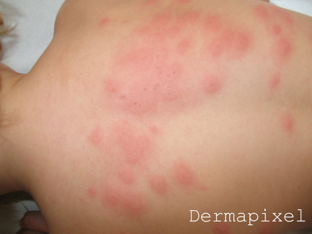 urticaria cuero cabelludo dermapixel picores rabiosos urticaria cuero cabelludo dermapixel picores rabiosos