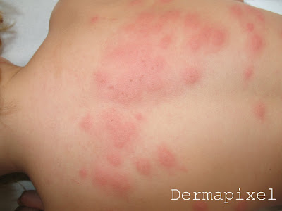 urticaria cuero cabelludo dermapixel picores rabiosos urticaria cuero cabelludo dermapixel picores rabiosos