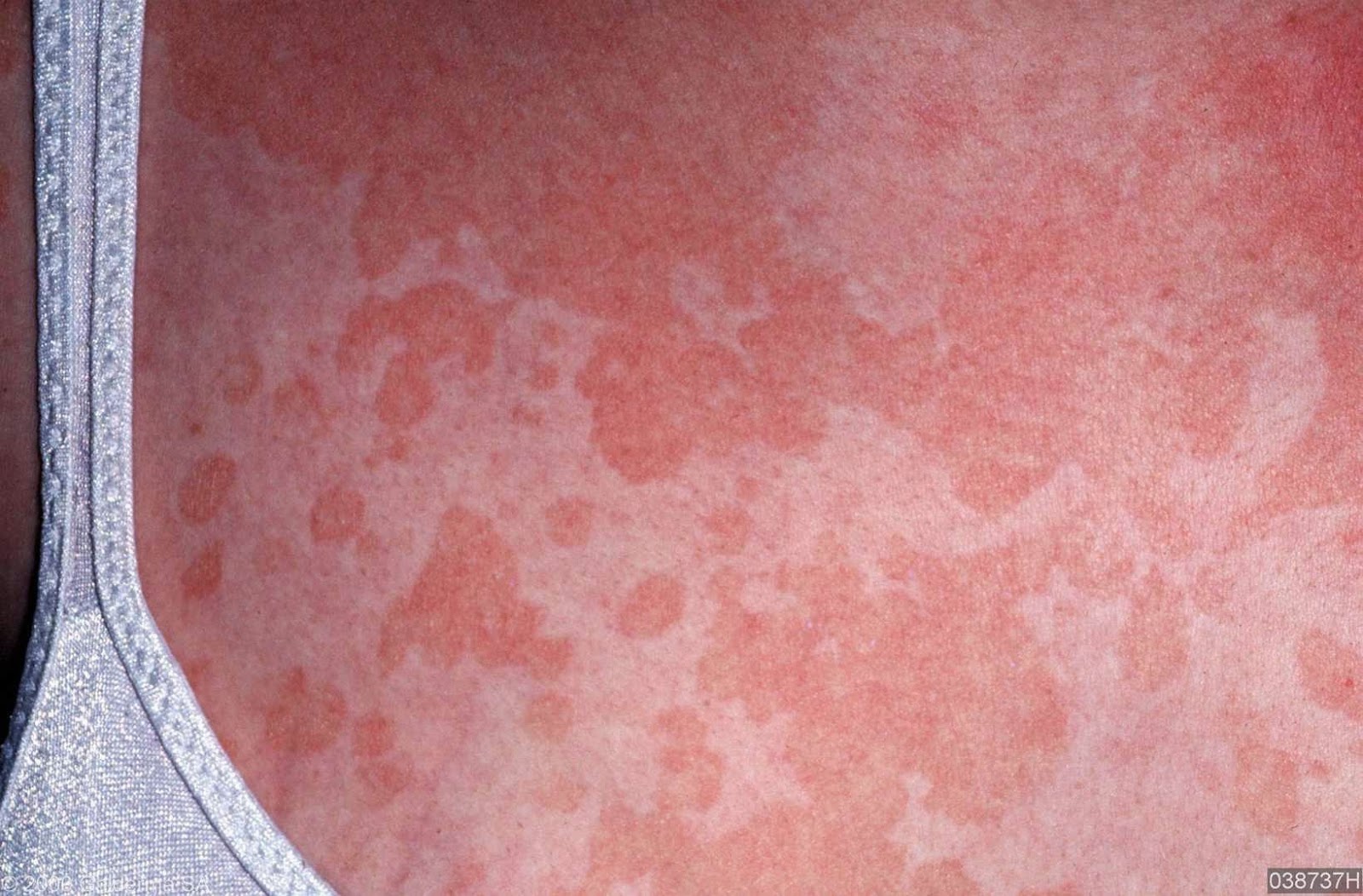 SKIN DISEASE TYPES Tinea Versicolor