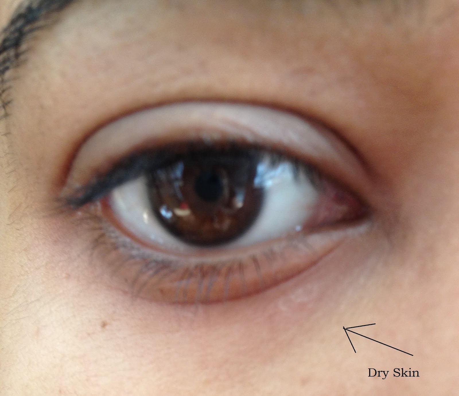 How to treat under eye edema