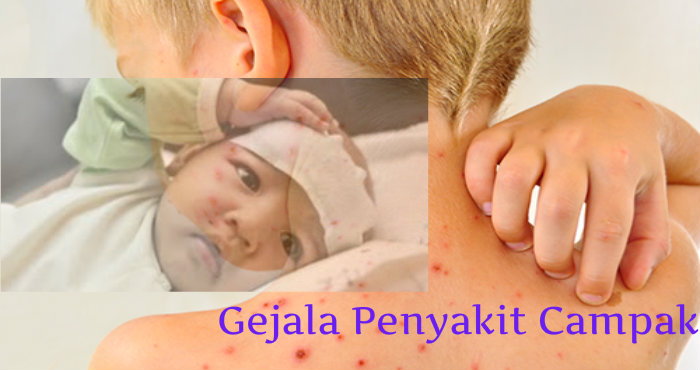 Penyebab dan Gejala Penyakit Campak Penyebab dan Gejala Penyakit Campak
