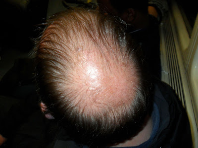 Bald Spot 1 - On the tube