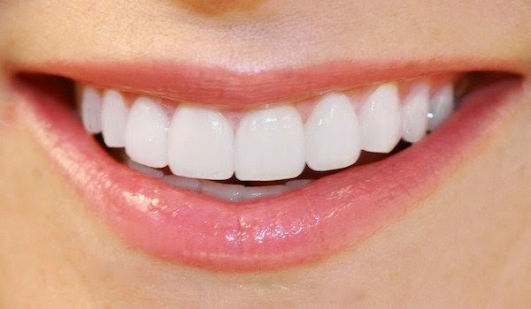 Cara Mudah Menghilangkan Karang Gigi Tanpa Harus ke Dokter