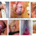 Cara Alami Menyembuhkan Wasir dengan Ambeclear thumbnail