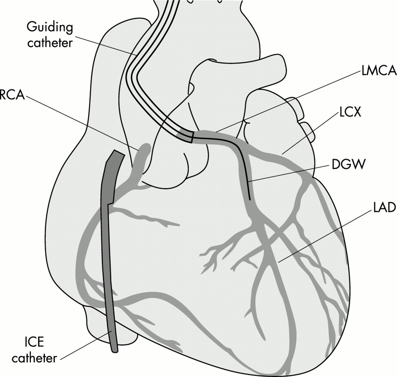 Ultimate Radiology Left Coronary Catheter