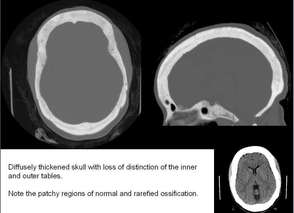 Skull and Spine Renal osteodystrophy and diffuse skull thickening
