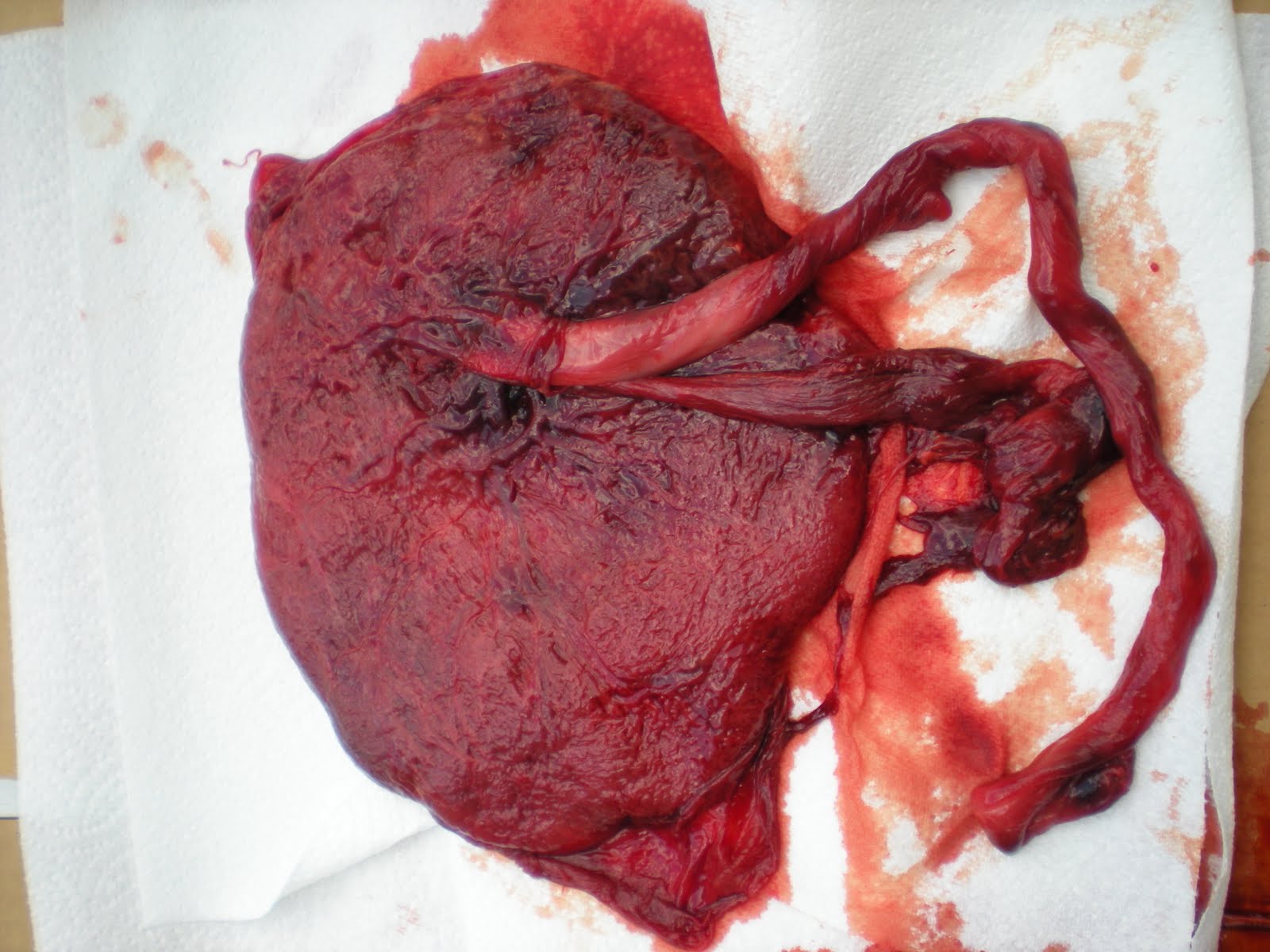 Eat Placenta