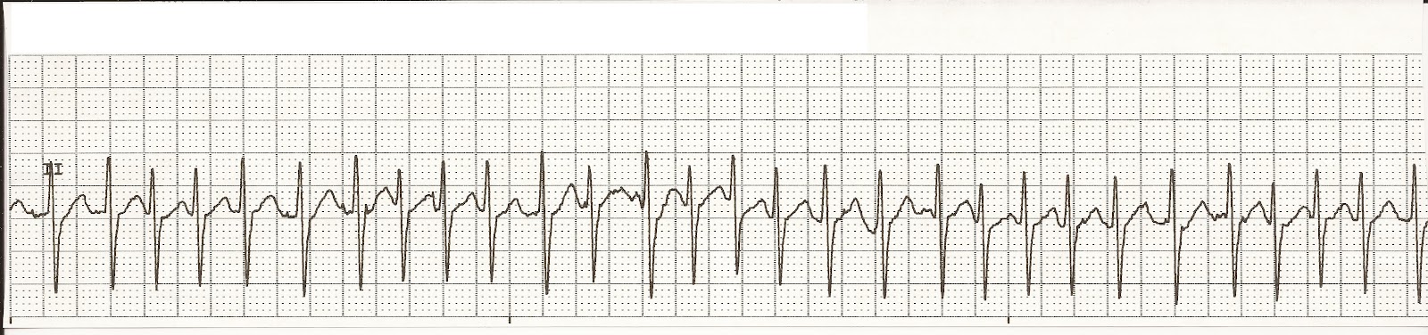 how fast to push iv diltiazem