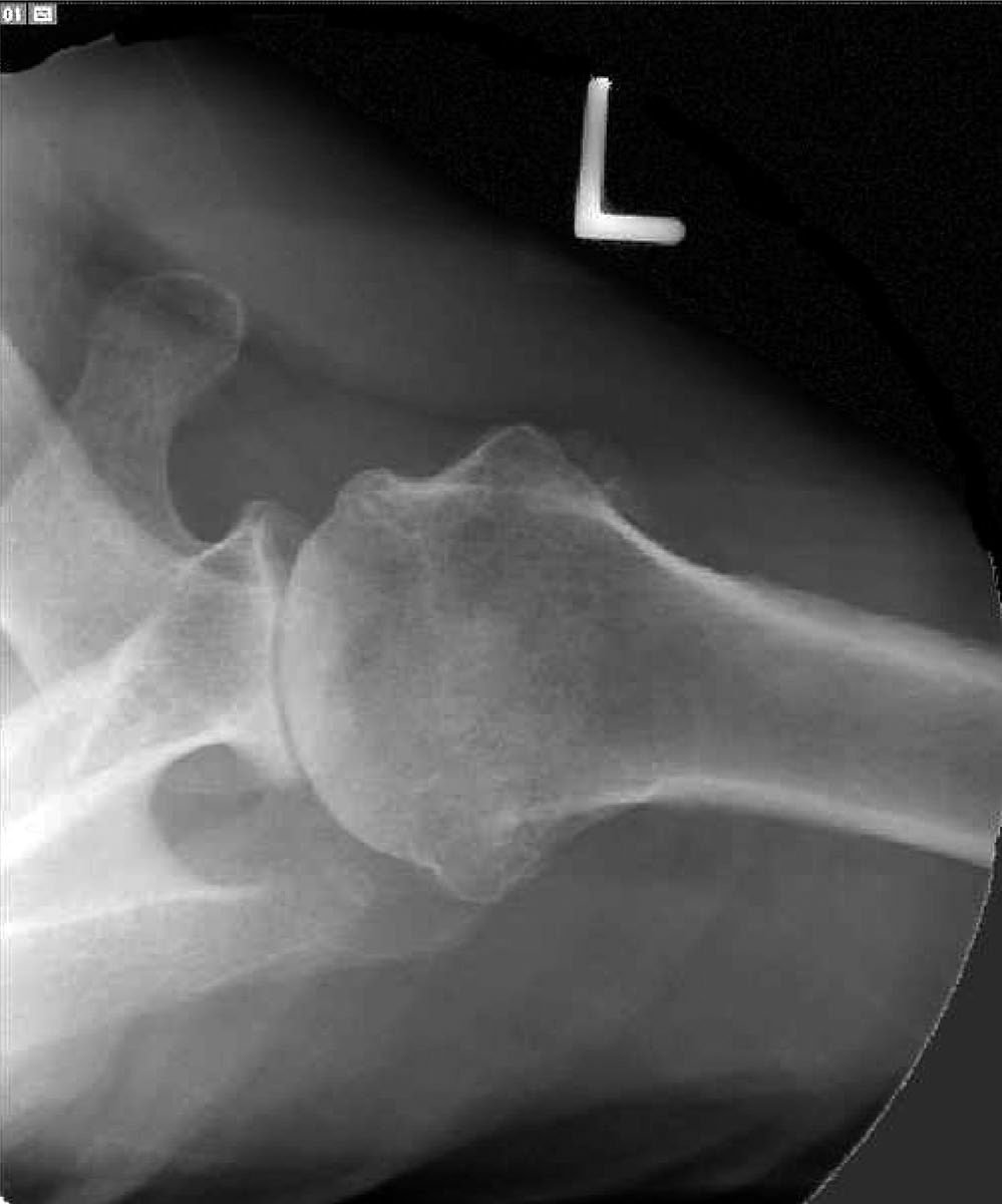 Shoulder Arthritis / Rotator Cuff Tears causes of shoulder pain Ream and Run for Shoulder