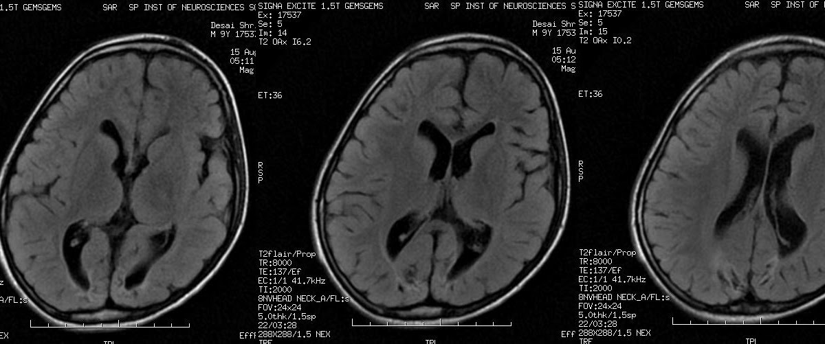 neuroradiology cases hypoxic ischemic encephalopathy mri hypoxic ischemic encephalopathy