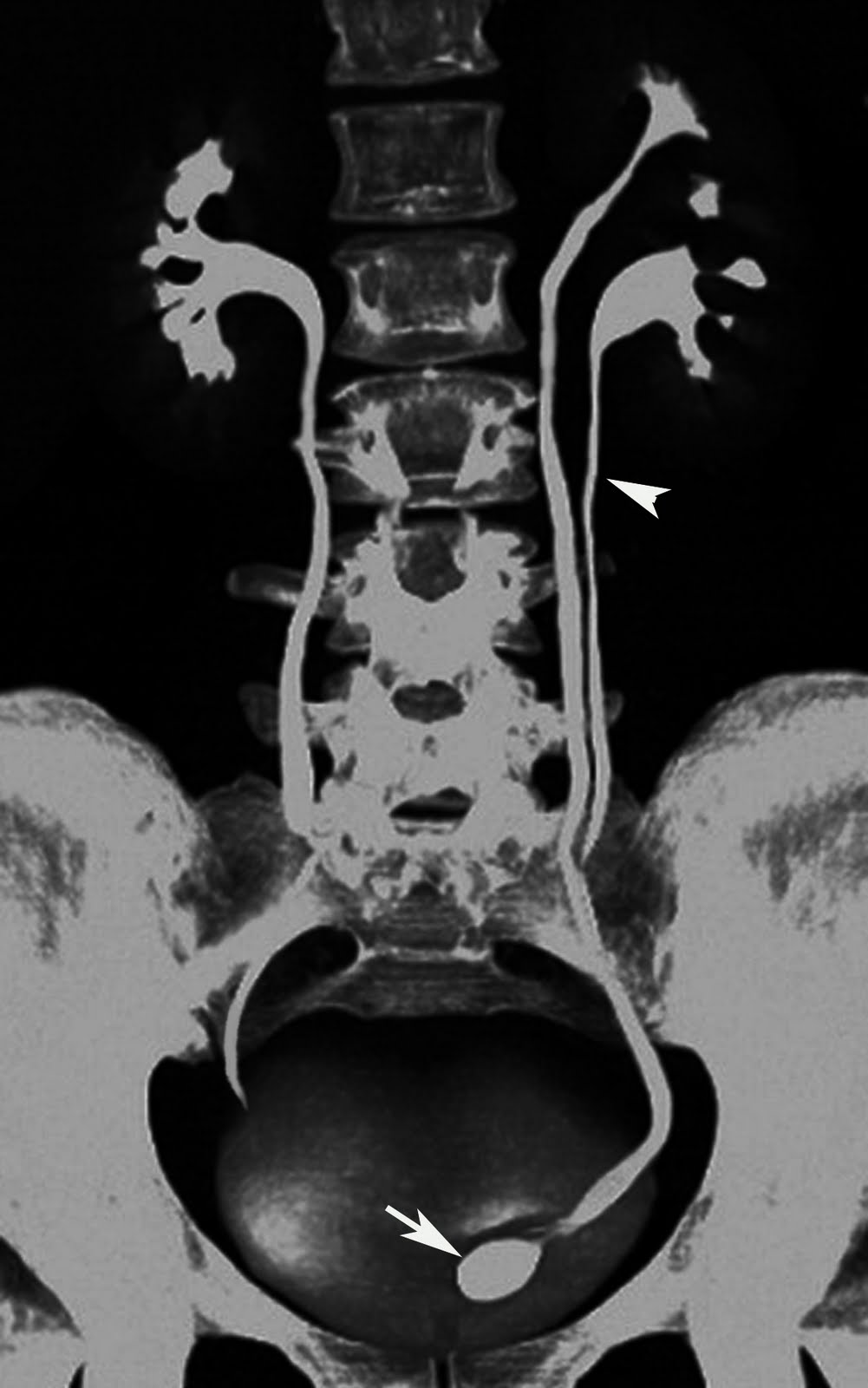 Duplex Ureter