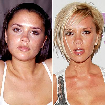 Victoria Beckham before and after picture (facial cosmetic surgery)