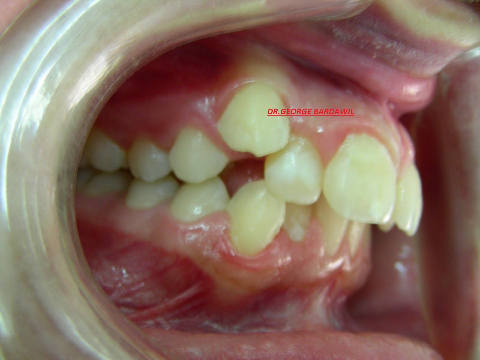 E. BardawilOrthodontistInvisalign Diamond level SUPRA