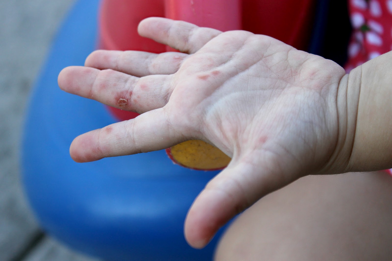 What I Did Today Today I Diagnosed My Child with Hand, Foot, and Mouth