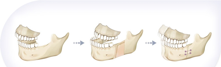 How To Fix A Crooked Jaw Without Surgery