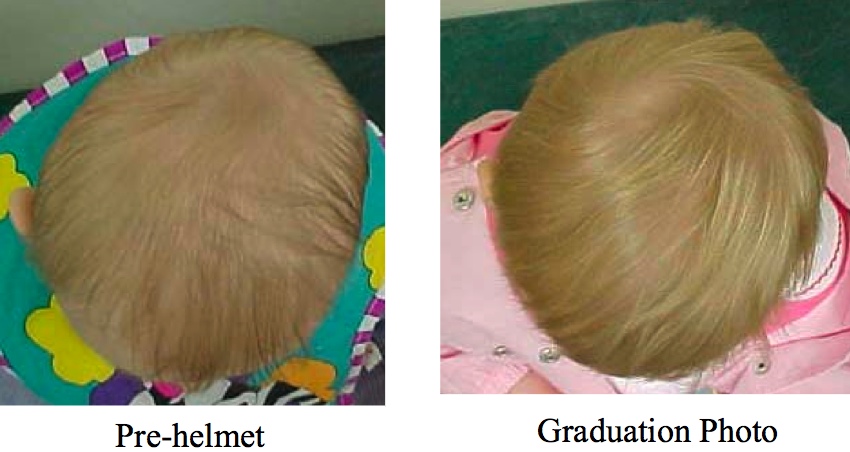 cranial remolding orthosis
