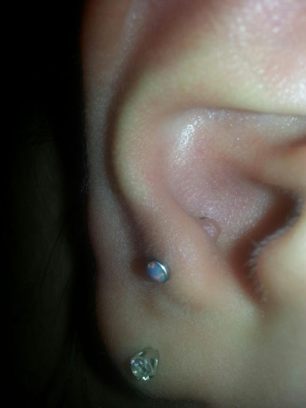 Hypertrophic scarring on my anti tragus title=