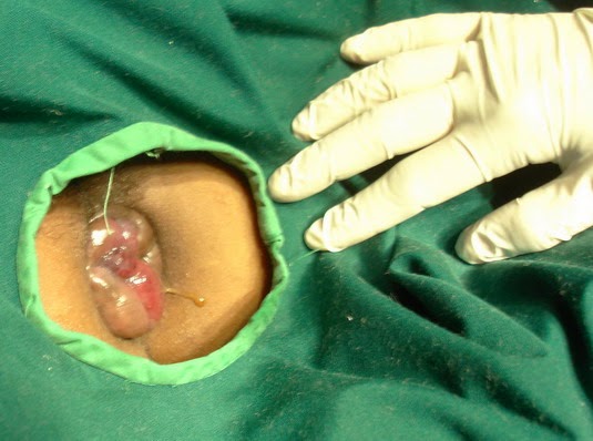 obat wasir apotik 2014, obat apotik wasir berdarah, cara membuat obat oles wasir