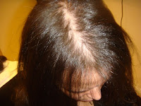 female hair loss