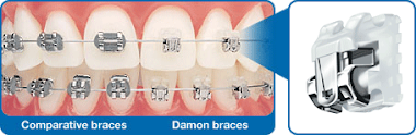 Damon braces