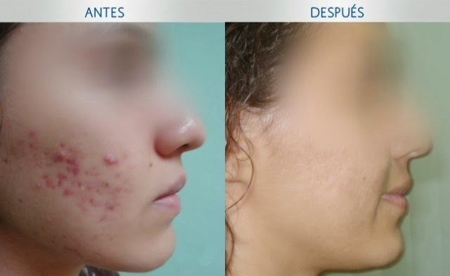 Tratamiento Para El Acne Tratamiento Para El Acne