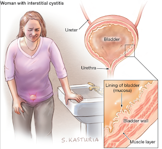 Interstitial Cystitis (IC) The Herbal Treatment of Interstitial Cystitis (IC) Or Painful Bladder Syndrome